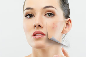 Howtoget rid ofstubborn chest acne? #WorldHealthDay
